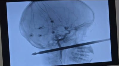 Xavier Cunningham, 10, fell from a tree house onto a meat skewer, which pierced his face, traveled into his skull and penetrated to the back of his head. Screen capture from USA Today